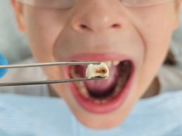 Best Broken or Cracked Tooth Emergency Dentist in Ripley, TN